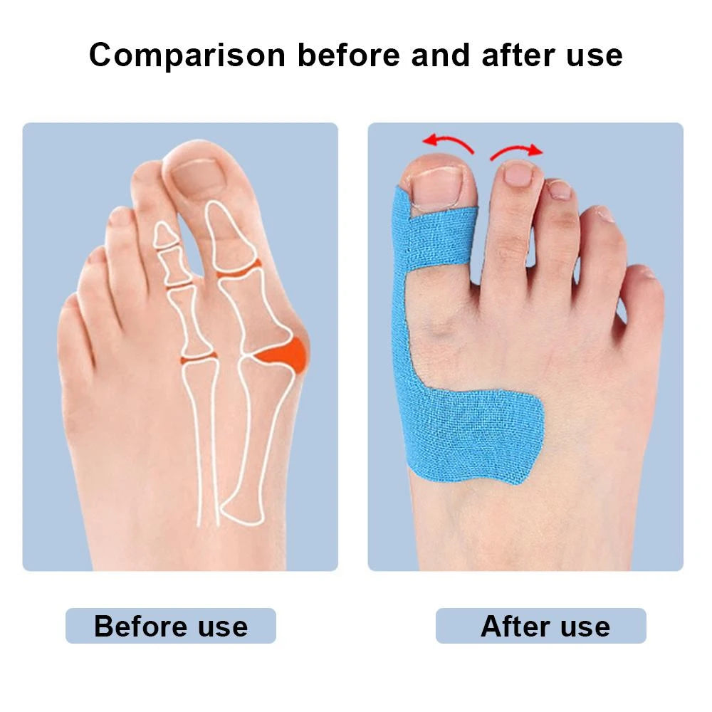 10PCS Bunion Corrector & Pain Relief Kinesiology Athletic Tape,For Bunions & Turf Toe,Big Toe Spacer/Separator/Straightener Tape