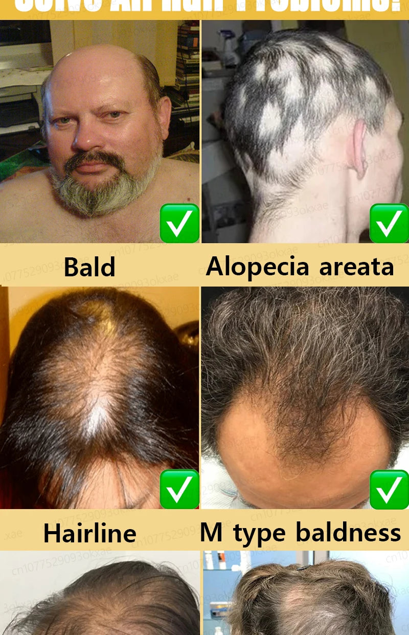 hair growth oil, Repair baldness, hairline, seborrheic alopecia hair care  fast shipping  hair oil