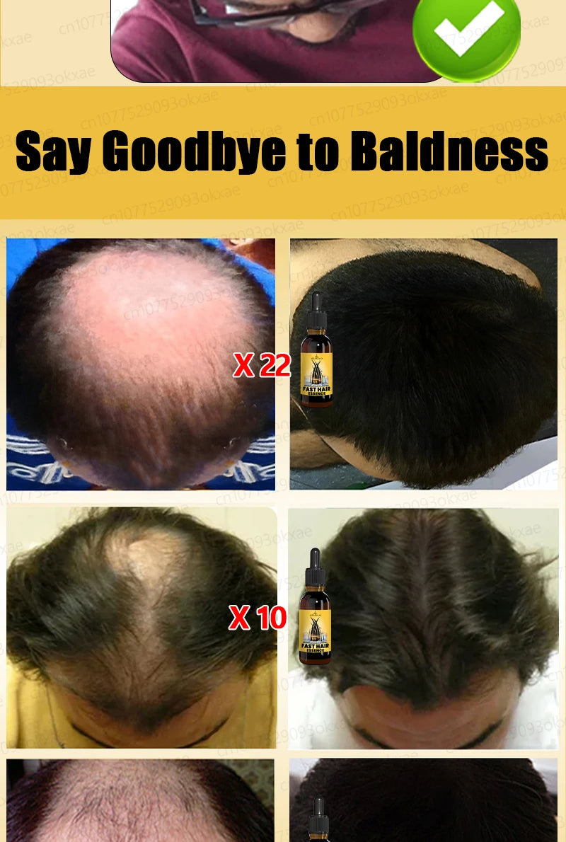 hair growth oil, Repair baldness, hairline, seborrheic alopecia hair care  fast shipping  hair oil