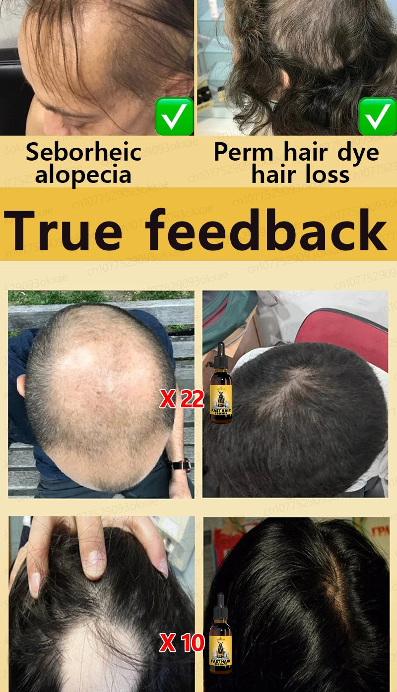hair growth oil, Repair baldness, hairline, seborrheic alopecia hair care  fast shipping  hair oil