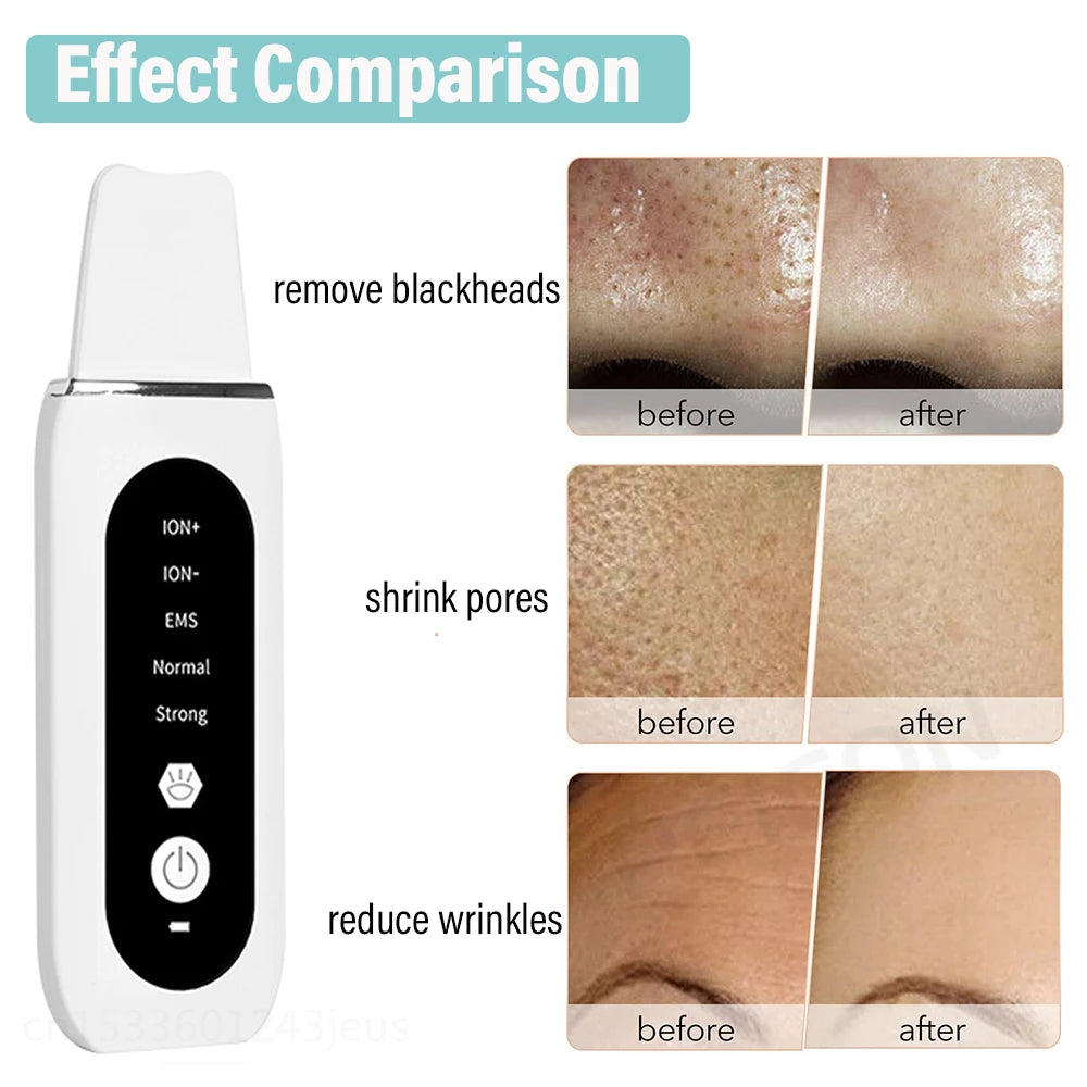Ultrasonic Skin Scrubber Facial Peeling Machine Face Scrubber Acne Pore Deep Cleaning Facial Cleaning Spatula Blackhead Remover