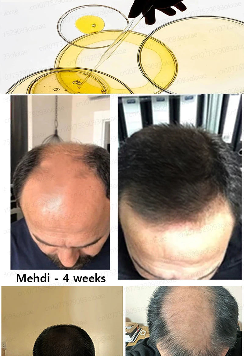 hair growth oil, Repair baldness, hairline, seborrheic alopecia hair care  fast shipping  hair oil